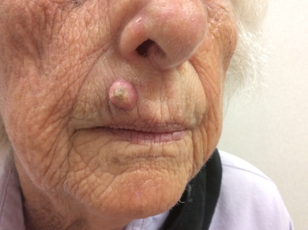 Skin cancer on lip