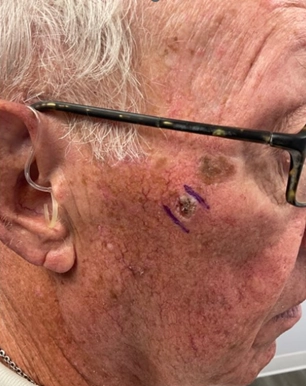 Close-up of an elderly man’s face showing a biopsy site on the cheek near the ear, with a purple surgical marker.
