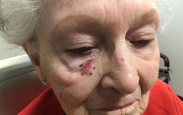 Elderly woman with a marked and bruised area under the left eye, indicating a recent skin cancer biopsy.
