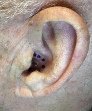 Close-up of an ear with multiple dark biopsy marks inside and around the ear canal, labeled with purple ink.