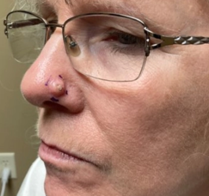 Middle-aged person with a small surgical site and purple marker on the nose, wearing eyeglasses.