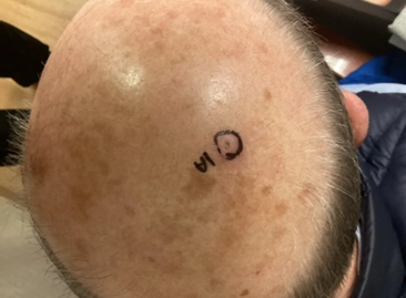 Top view of a bald scalp with a small biopsy circle marked with “1A” in purple ink.