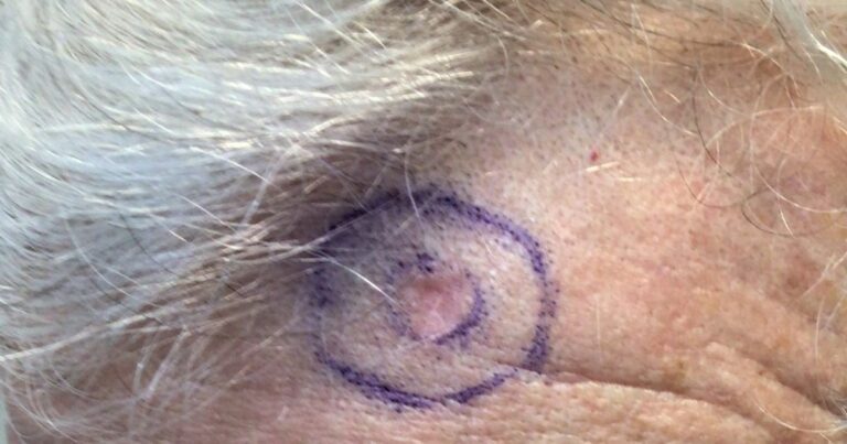 Skin cancer marked on patient's forehead.