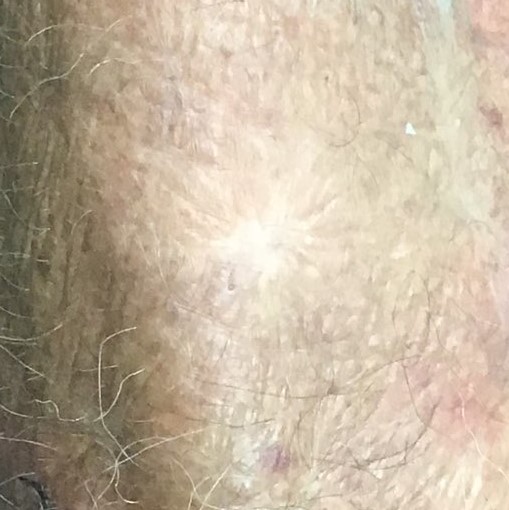 After shot of skin cancer treatment on lower arm.
