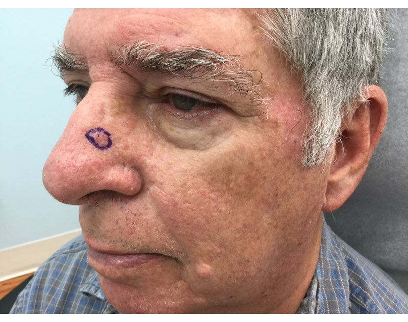 What does nose skin cancer look like?