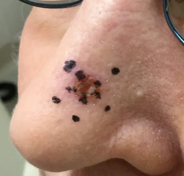 Close-up view of the side of a person's nose with a reddish-brown lesion surrounded by several small black marker dots, indicating the site of a skin biopsy for suspected skin cancer.