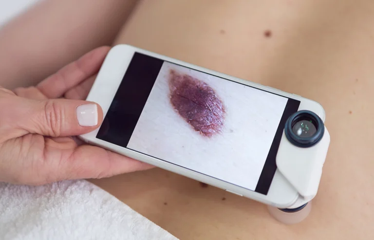 Person using smartphone to photograph and analyze a dark mole on skin for possible signs of skin cancer.