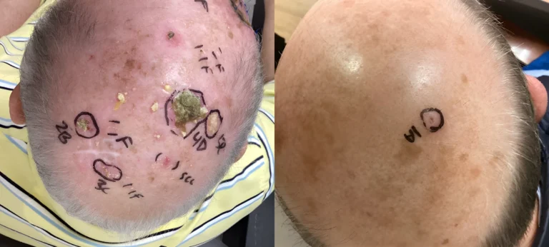 Before and after clinical photos of the top of a patient’s scalp showing multiple marked skin lesions prior to treatment on the left, including a larger central lesion, and a healed scalp on the right with clear skin and minimal visible markings after treatment.
