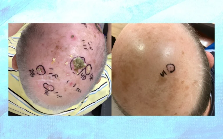 Before and after clinical photos of the top of a patient’s scalp showing multiple marked skin lesions prior to treatment on the left, including a larger central lesion, and a healed scalp on the right with clear skin and minimal visible markings after treatment.