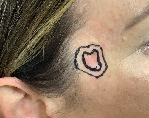 Flat pink patch on sun exposed skin with mild scaling, shown as an example of what a flat skin cancer spot can look like